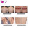 Best Type of Laser Hair Removal Machine