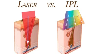 Which Laser Is Better IPL Or Diode?