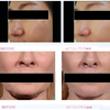 Pulselift machine Exclusive Technology Stimulates Facial Muscles