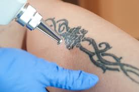 How Many Sessions Are Typically Required for Complete Tattoo Removal?