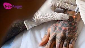 How to safely get a tattoo removed 