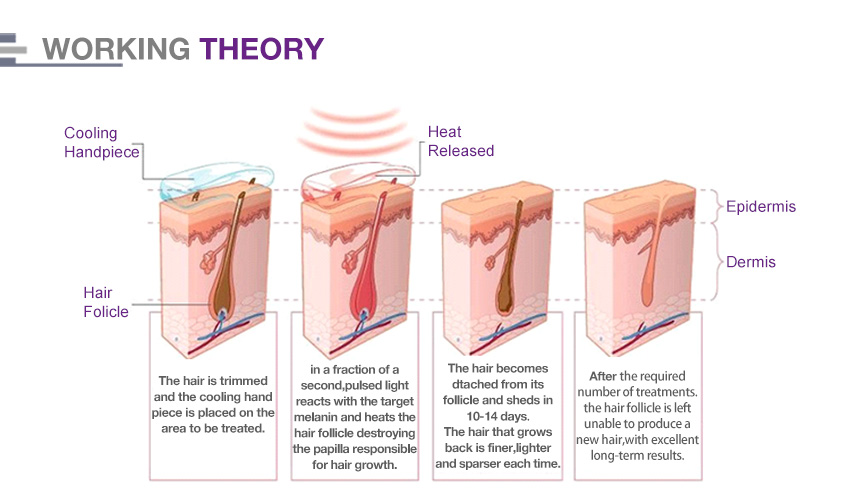 Best Professional Laser Hair Removal Machine 2018 For All Colors