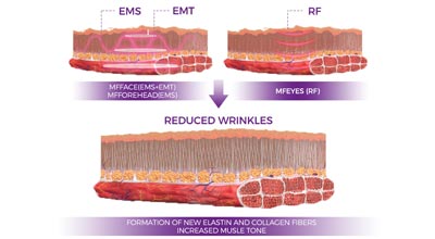 The Art and Science of Facial Muscle Lifting with EMS Technology