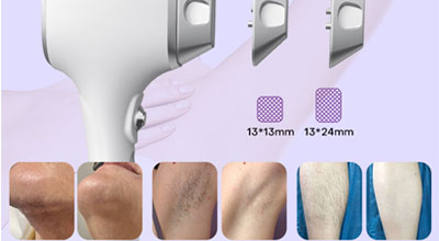  Is Diode Laser Better Than IPL?