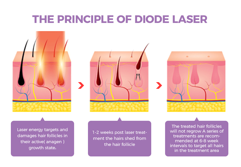 What is Diode laser machine  Treatment Procedures, Conditions Treated,  Benefits of Diode laser machine - SkinGenious.