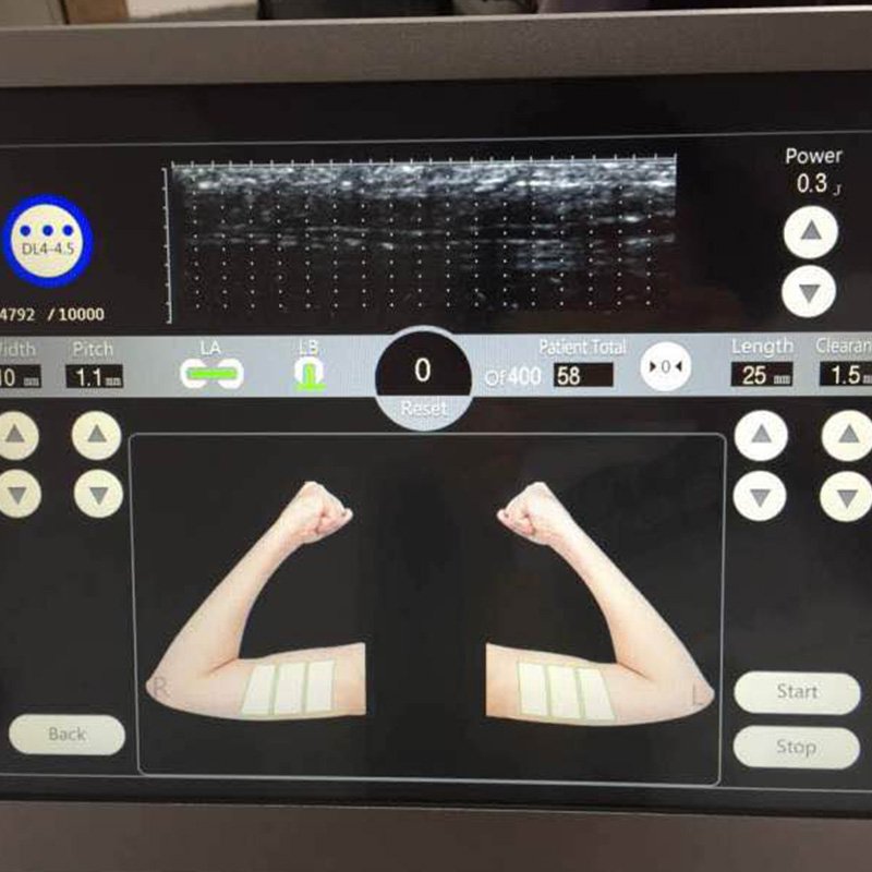 Hifu High Intensity Focused Ultrasound Machine Wrinkle Removal